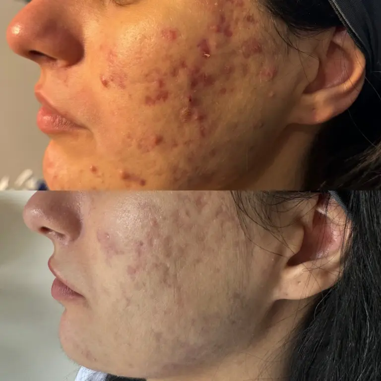 laser acne treatment