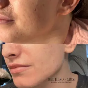 co2 fractional laser before and after