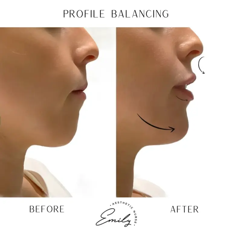 FFR-profile-balance-lip-chin-