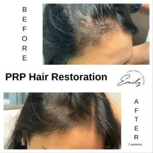 hair loss treatment