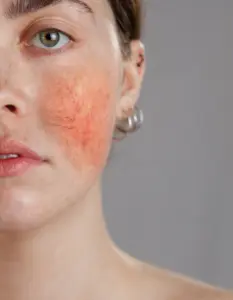 rosacea