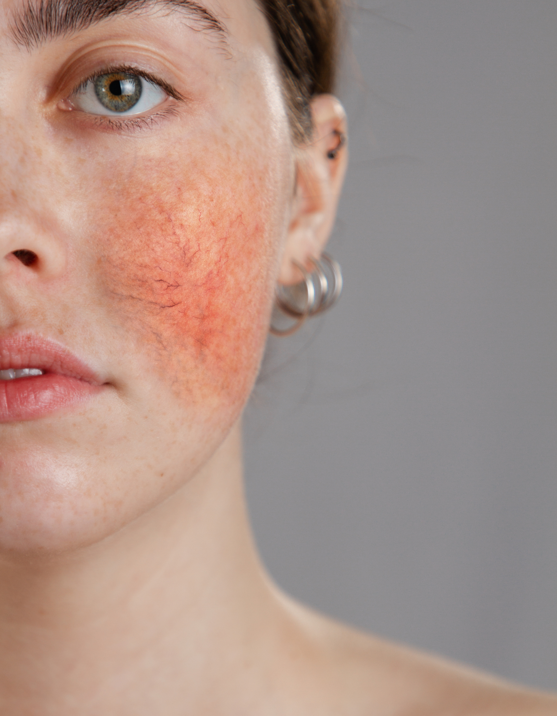 rosacea