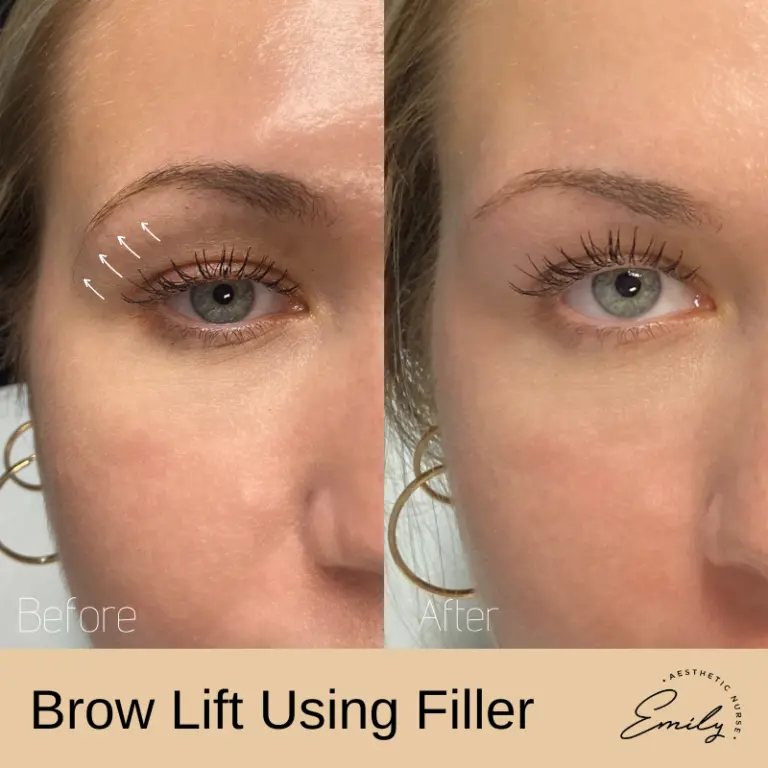 brow-bone-filler-