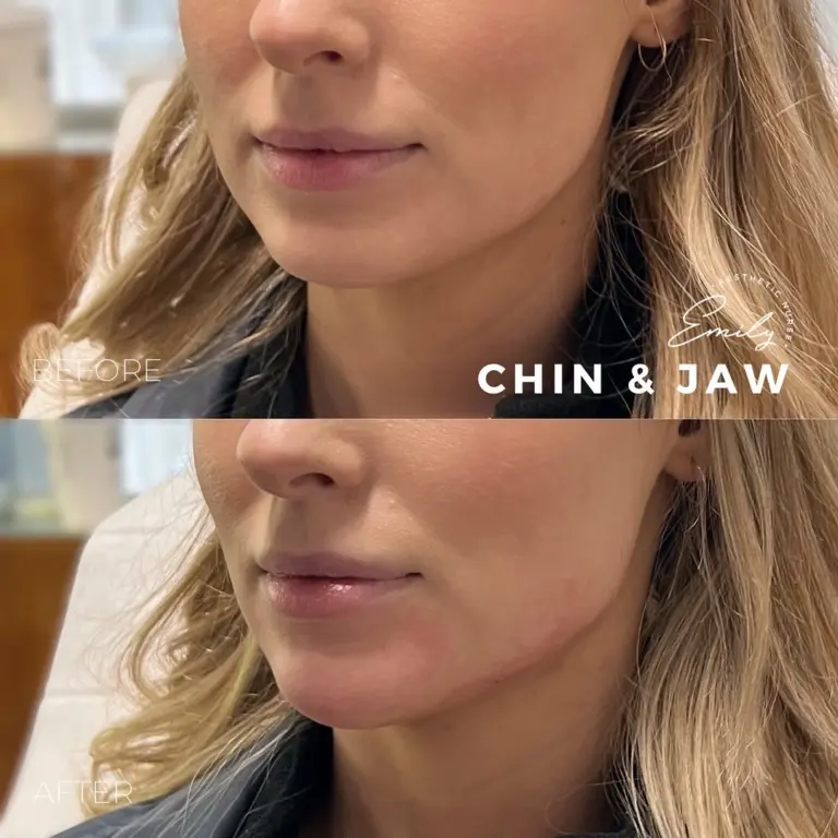 chin-and-jaw