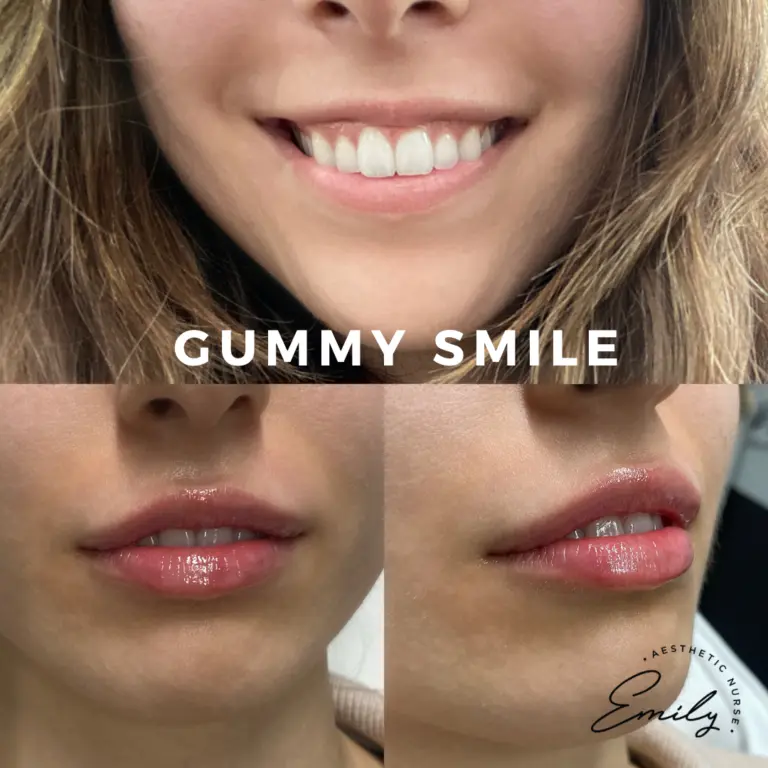 gummy-smile-lip-and-botox