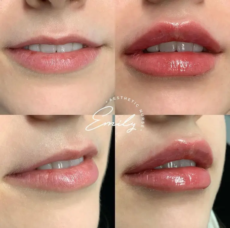 lip-botox-lip-flip-