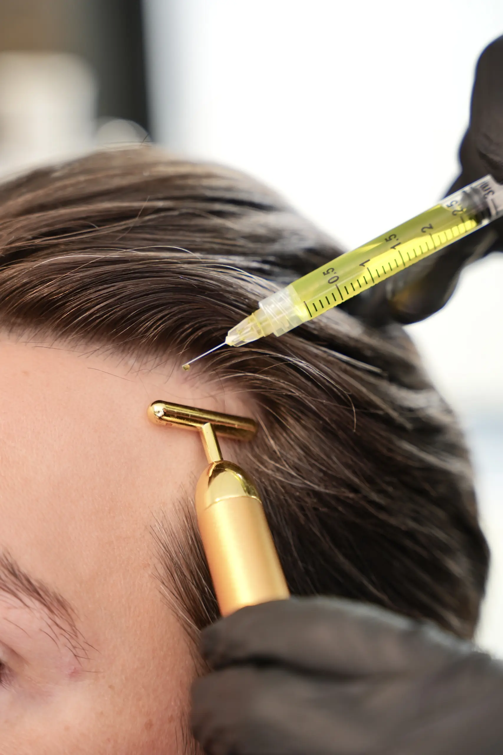 prp hair treatment