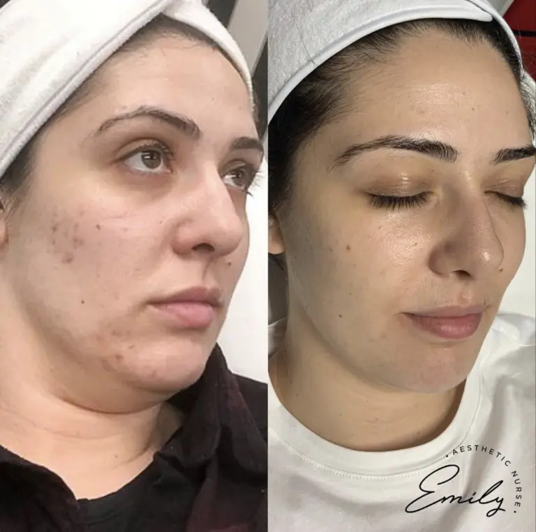 SkinPen Microneedling