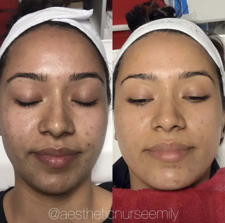 microneedling treatment