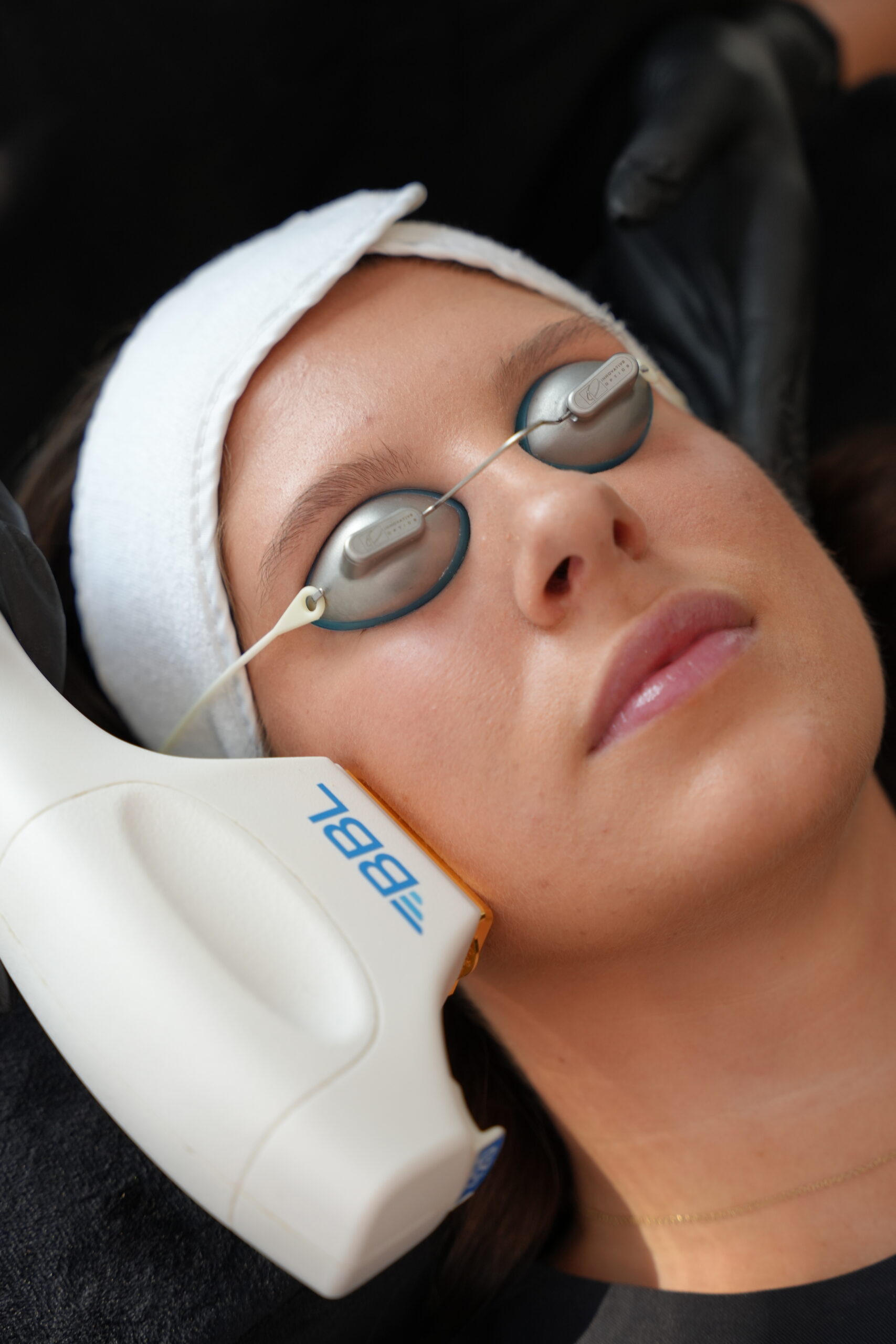 acne scar treatment